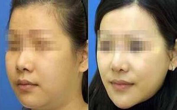 杭州華山整形醫(yī)院陳敬武隆鼻修復(fù)效果如何評(píng)價(jià)