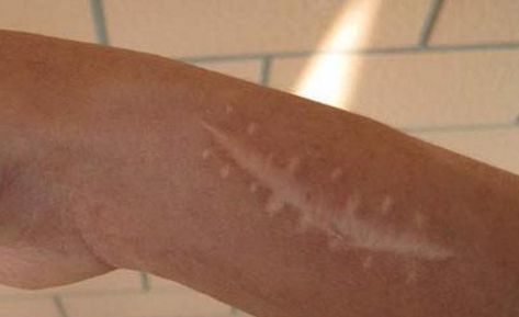 南京哪家醫(yī)院的疤痕修復(fù)效果最佳？