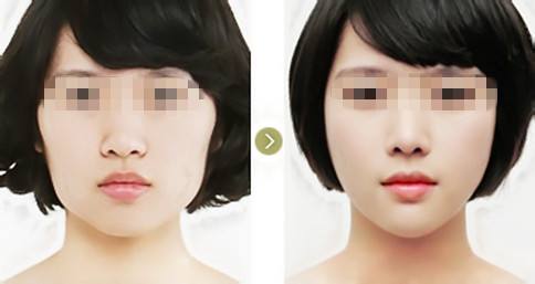 2023廣西達拉斯綜合鼻整形正規(guī)醫(yī)生上榜前10名(李偉、劉達恩、鐘江是比較權(quán)威的)