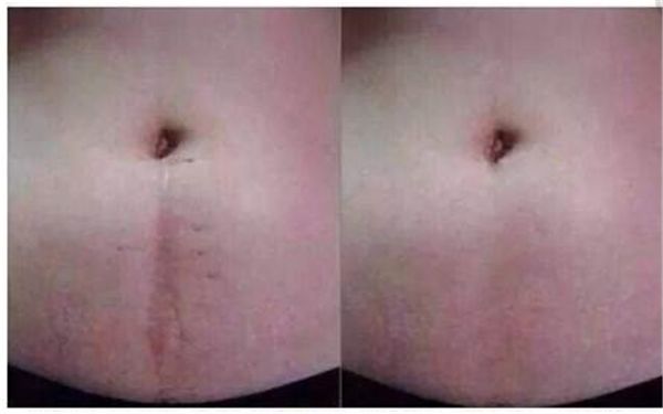 深圳哪家醫(yī)院專業(yè)治療傷疤效果好？