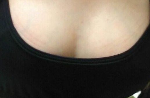 青島哪家醫(yī)院雙眼皮手術(shù)效果好，術(shù)后無(wú)后顧之憂