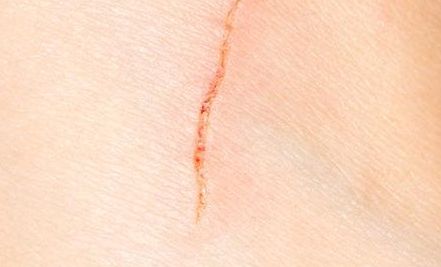 浙江開(kāi)眼角哪家醫(yī)院技術(shù)好？選擇哪家醫(yī)院效果最佳