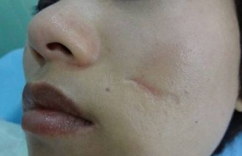 吉林市切開雙眼皮哪家好？一篇詳細的雙眼皮手術評測指南。