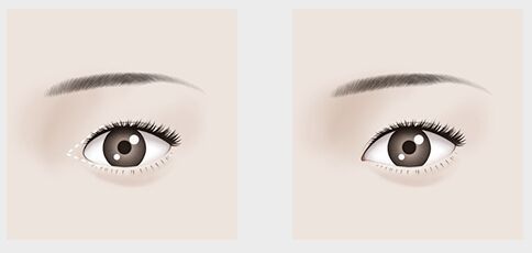 【2023年上海整形醫(yī)院哪家做眼袋好？專業(yè)醫(yī)生推薦評比】