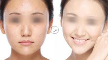 廣州哪家醫(yī)院去黑頭好？揭秘廣州專業(yè)祛黑頭效果最佳的醫(yī)療機構(gòu)