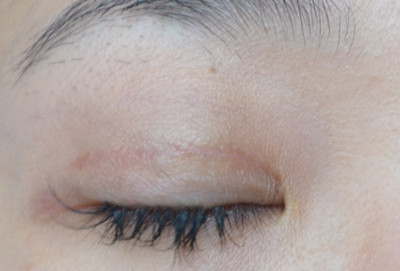 2023上海嗨體去抬頭紋排名前十的專家(張芝演、董佳生、李鎬均這些正規(guī)專家推薦給你)