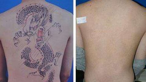 怎樣修復(fù)鄭荃疤痕，讓人滿意？