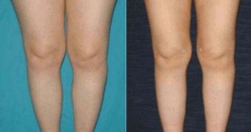 包頭有哪些靠譜的醫(yī)院能做好雙眼皮切開手術(shù)？