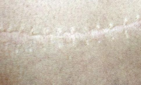 聊城玻尿酸隆鼻哪家好？專業(yè)醫(yī)生推薦幫助您選擇