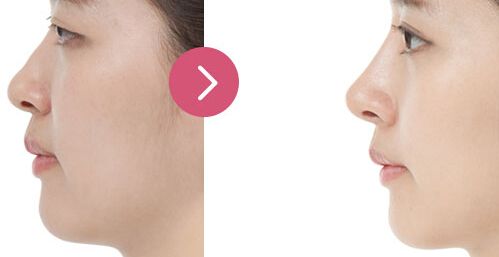 廣州哪家醫(yī)院眼部整形效果好，專業(yè)醫(yī)院推薦