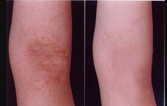 煙臺(tái)雙眼皮醫(yī)院哪家好？選專(zhuān)業(yè)技術(shù)高超、口碑好的醫(yī)院推薦