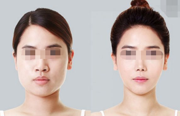 雙眼皮消腫速度？這個方法幫你快速恢復！