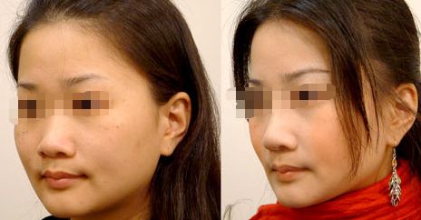 廣州海峽雙眼皮好評如潮，有效突顯雙眼魅力