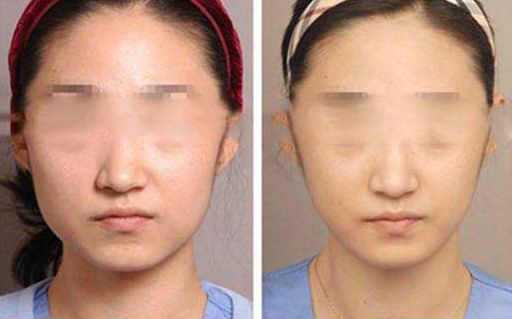 臀部吸脂手術：詳解夢寐以求的豐臀過程