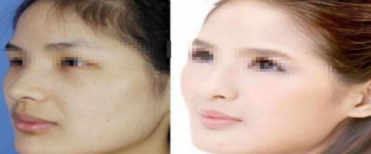 注射隆鼻的價格預算是多少呢