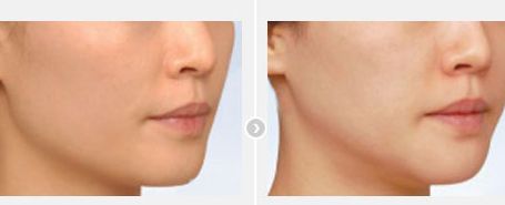 北京最受歡迎的雙眼皮修復(fù)醫(yī)生，多位滿意的患者推薦！