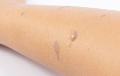 哈爾濱宋桂霞醫(yī)生為您解析雙眼皮手術的獨到體驗