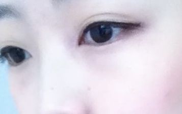 劉月麗醫(yī)生的雙眼皮修復(fù)技術(shù)在鄭大二附院備受矚目