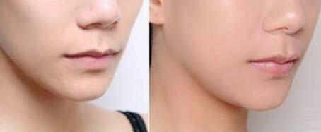 深圳徐斌的隆胸手術(shù)值得信任嗎？