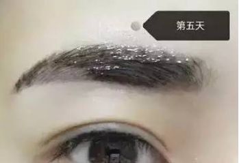 南昌美伊爾劉立軍醫(yī)生膨體隆鼻整形費(fèi)用？手術(shù)效果如何？帶您看醫(yī)生案例