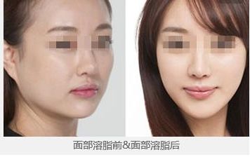 鄭州望京張鵬隆鼻2023年實力及成功案例公開，讓您放心無憂