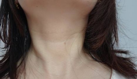 江華教授隆胸術(shù)，口碑與收費(fèi)詳解