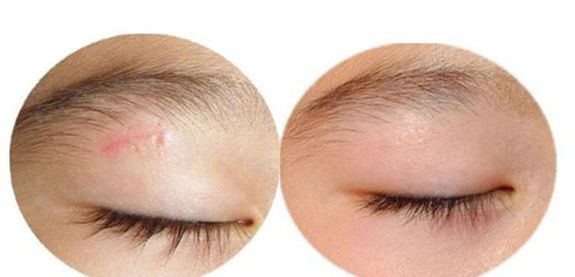 廣州曙光醫(yī)院雙眼皮手術(shù)手藝高超，名醫(yī)推薦！附真實(shí)案例！