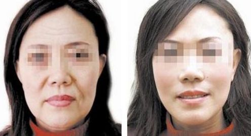 選娜楚玻尿酸還是伊婉？一篇幫你深度對(duì)比分析