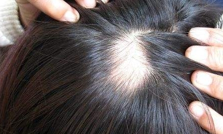 南京新生醫(yī)院植發(fā)效果如何？坐診專家簡(jiǎn)介、詳細(xì)地址一覽