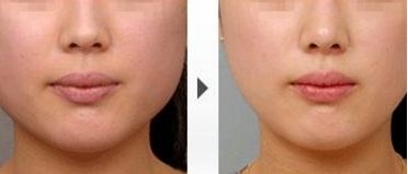 上海五位雙眼皮技術(shù)高超的專家匯總，排名唯一出爐