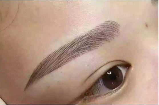 武漢葉子榮做拉皮的療效如何？專家醫(yī)生分享經典案例