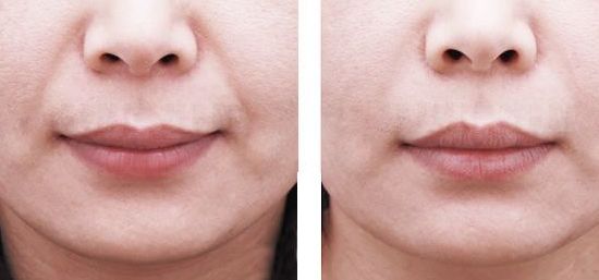 重慶藝星王永久醫(yī)生雙眼皮效果如何？90天招牌案例公開揭曉