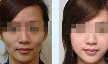 綿陽哪家醫(yī)院做雙眼皮效果好