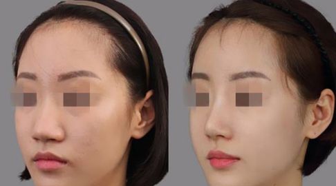 祛斑攻略：探秘激光去斑價格及術(shù)后護理要點