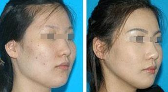 揭秘鵬程整形明星項目，實力專家為您塑美容顏！