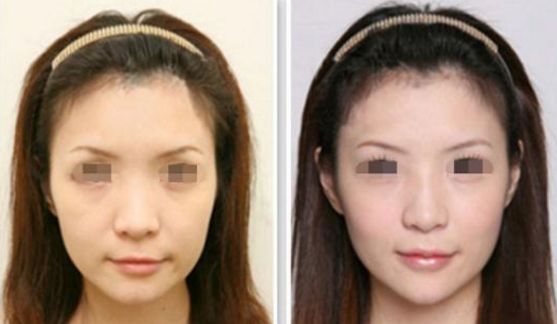 西安整形醫(yī)院吸脂減肥排行榜前五，用戶首選