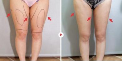 常州哪家醫(yī)院做玻尿酸效果好？