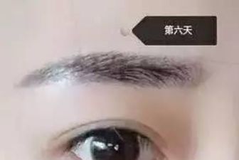 成都江濤雙眼皮術(shù)醫(yī)生坐診地點(diǎn)及案例分析