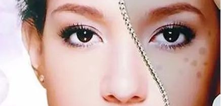 周一雄如何預(yù)約雙眼皮手術(shù)？案例分享與價格真實(shí)評估