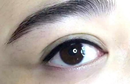 福州去眼袋去哪里效果好？哪家醫(yī)院專業(yè)可信？