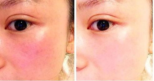 東莞鼻整形專家薈萃！治療頑固鼻部問題有招！