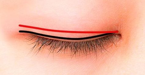 曹衛(wèi)剛修復雙眼皮技藝優(yōu)異，想知道他的專長嘛？進來看看吧！