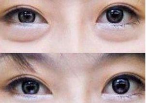 朝陽(yáng)區(qū)雙眼皮手術(shù)就找TA！專家力推朝陽(yáng)二醫(yī)院頂級(jí)雙眼皮醫(yī)生