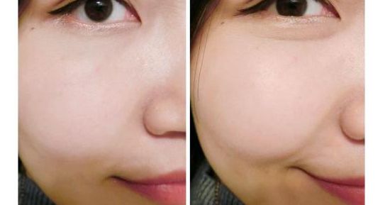 最佳專家推薦：成都五位頂級醫(yī)生精準玻尿酸注射排行榜