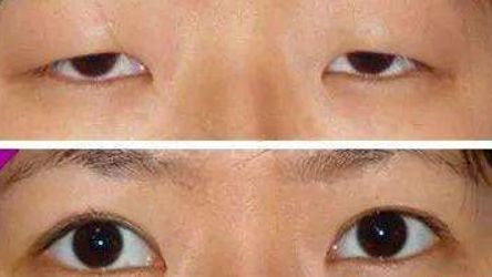 金華麗都整形為您呈現(xiàn)：雙眼皮神奇案例揭秘，專家力薦！