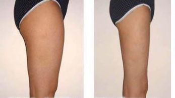 膨體隆鼻的潛在風(fēng)險(xiǎn)與并發(fā)癥探討