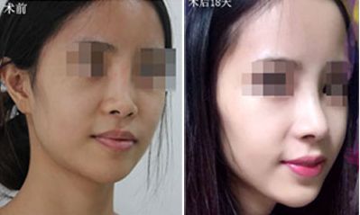 深圳哪家醫(yī)院隆胸效果好？排名前五火熱推薦！