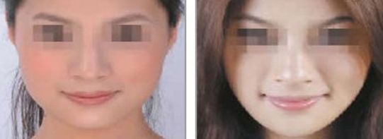 2024年適合自體豐胸的沈陽醫(yī)院有哪些好選擇？