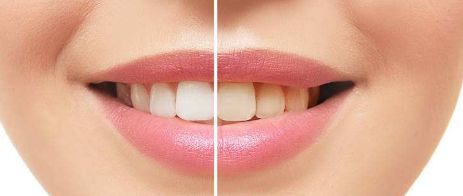 上海亞太整形醫(yī)院2023年隆鼻案例發(fā)布，廣受好評(píng)！