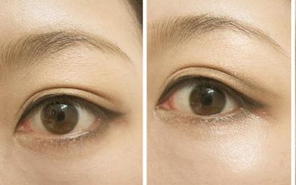 沈燕華醫(yī)生雙眼皮技術(shù)值得信賴(lài)，術(shù)后效果受到患者一致好評(píng)！